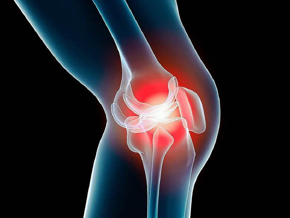 osteoarthritis of the knee